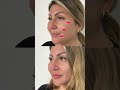 Luce más joven y bella en pocos minutos - Rejuvenecimiento facial Gabriela Redux Clínica