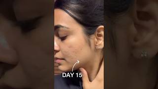 TRETINOIN for Acne Scars 30 DAYS #shorts