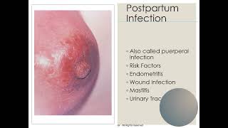 Postpartum Complications