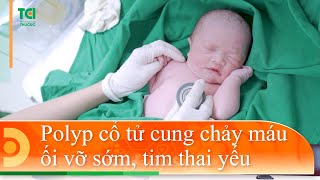 Polyp cổ tử cung chảy máu, ối vỡ sớm, tim thai dao động kém