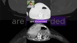 I almost gave up reporting this one | CT SCANS Ep. 9 #medicalimaging #ctscan #radiology #lungcancer