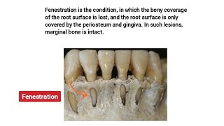 Fenestration Vs Dehiscence  | NEET MDS 2025 preparations - Dr. Faiza MDS