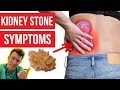 What symptoms do KIDNEY STONES cause? Doctor explains...PLUS how kidney stones are diagnosed & more!