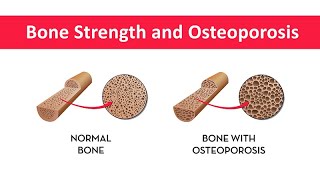 Bone Strength and Osteoporosis