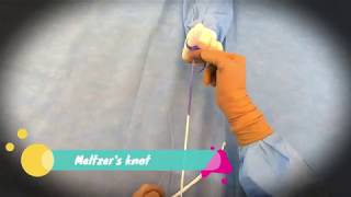 Laparoscopic Meltzer's Knot