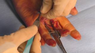 Hand Fracture System Cadaveric Lab Part 4: Avulsion Hook Plate