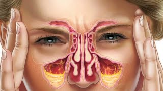 Sinusitis Problem Leiba Allergy Oiganba Meeoisingi|| Chaba Yaba Yadaba||Manipur