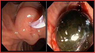 ERCP Stone Extraction l ERCP l ইআরসিপি করে পাথর বের করা #BD_ENDOSCOPY