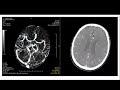 Left MCA Ischaemic Stroke