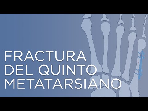 Cuanto tarda en soldar una fractura del quinto metacarpiano?