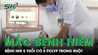 Mắc Hội Chứng Hiếm Gặp, Bệnh Nhi Được Phẫu Thuật Loại Bỏ 5 Polyp Trong Cơ Thể I SKĐS