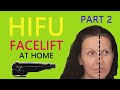 HIFU Face Lift at Home - PART 2 demonstration and review