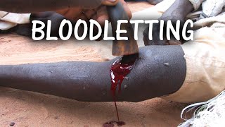 Modern Day Blood-letting in Africa