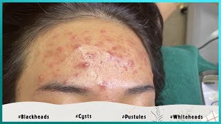 Big Cystic Acne Blackheads Extraction Blackheads \u0026 Milia, Whiteheads Removal Pimple Popping