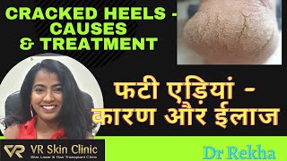 मुलायम  एड़ियाँ कैसे पाएं|Cracked heels- Causes & Treatment |Dr Rekha |Bikaner Dermatologist| VR Skin