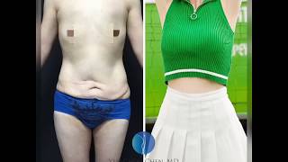 內視鏡隆乳 + 360度抽脂腹部整形 + 臀部脂肪移植 - 產後形體雕塑陳彥州醫師
