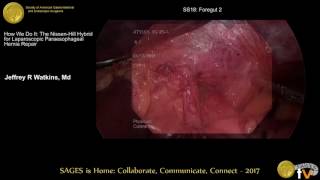 How we do it: The Nissen-Hill hybrid for laparoscopic PEHR