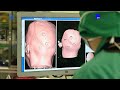 transforming neurosurgery with naotrac robot – interview with gokhan zorlubas u0026 josef de pfeiffer