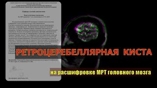 АРАХНОИДАЛЬНАЯ РЕТРОЦЕРЕБЕЛЛЯРНАЯ КИСТА головного мозга на РАСШИФРОВКЕ МРТ головного мозга