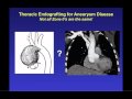 Endovascular Stent Grafting for ascending and aortic arch repair by John Ikonomidis MD Part 2.mov