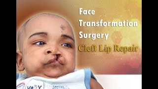 Effective Unilateral Cleft Lip Repair Technique \u0026 Scar Free Results|Best Cleft Lip Surgery In Kerala