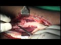 Tendon transfer for radial nerve palsy - Dr Darshan Kumar A. Jain