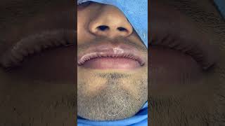 Best Upper Lip reduction surgery in India - Facial Plastic Surgery