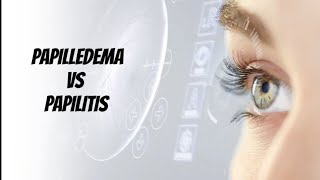 Papilledema VS Papillitis (Optic neuritis)..