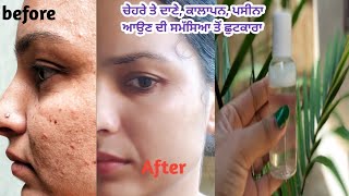 ਮੈਂ ਕਿਵੇਂ ਕਲੀਅਰ ਕੀਤਾ ਆਪਣੇ ਚੇਹਰੇ ਨੂੰ🥰No pimples No sun Tan🌞Get glowing skin