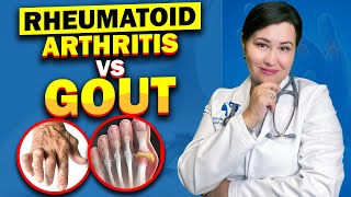 Rheumatoid Arthritis and Gout - How to Differentiate ? | Explained by a Rheumatologist