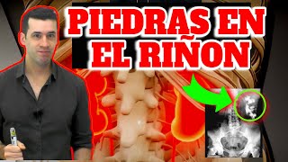 ¡ESTOS SINTOMAS PUEDEN SER PIEDRAS EN LOS RIÑONES!| LITIASIS RENAL - Dr Veller