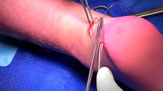 Professor Al Muderis performs Achilles Laceration Repair