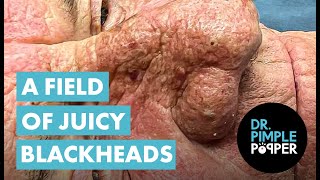 A FIELD OF JUICY BLACKHEADS