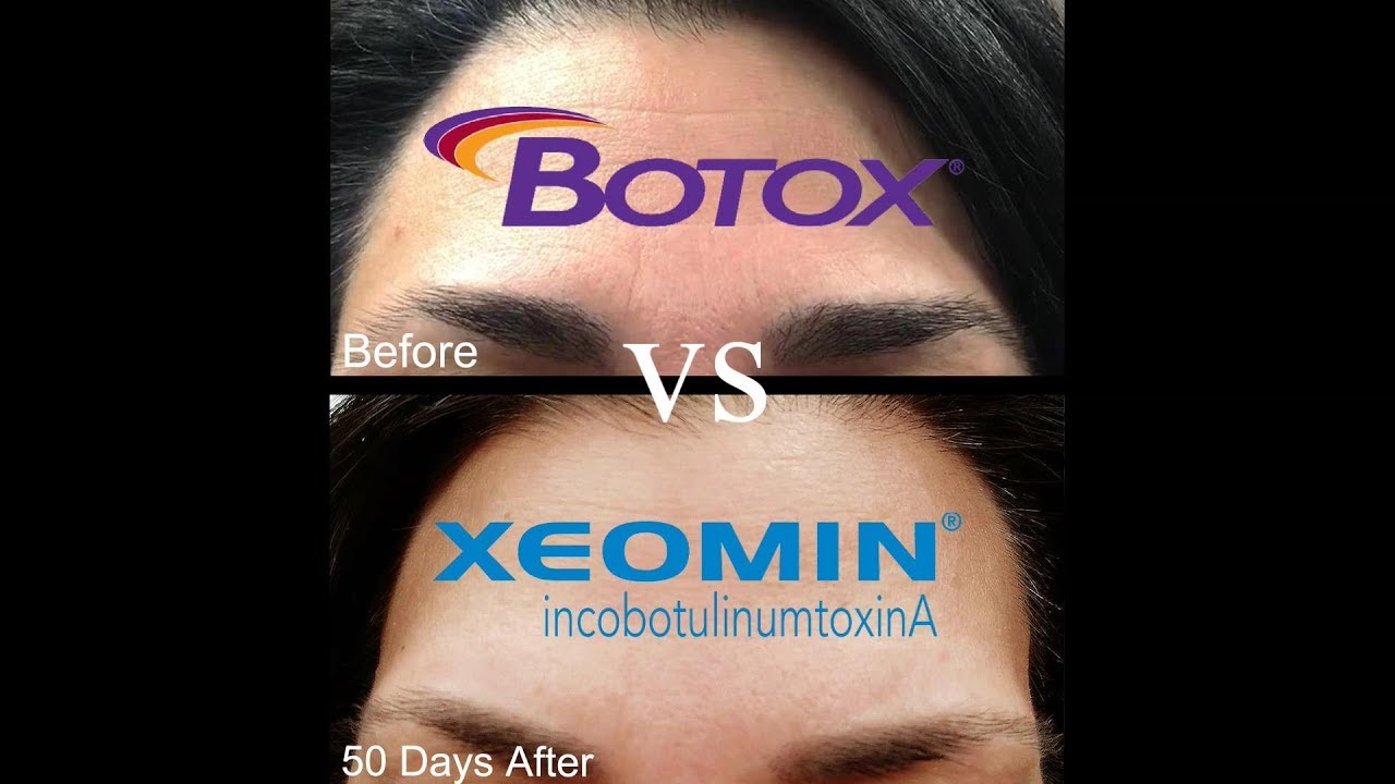 Botox® Vs Xeomin® Challenge - 50 Days Later - YouTube