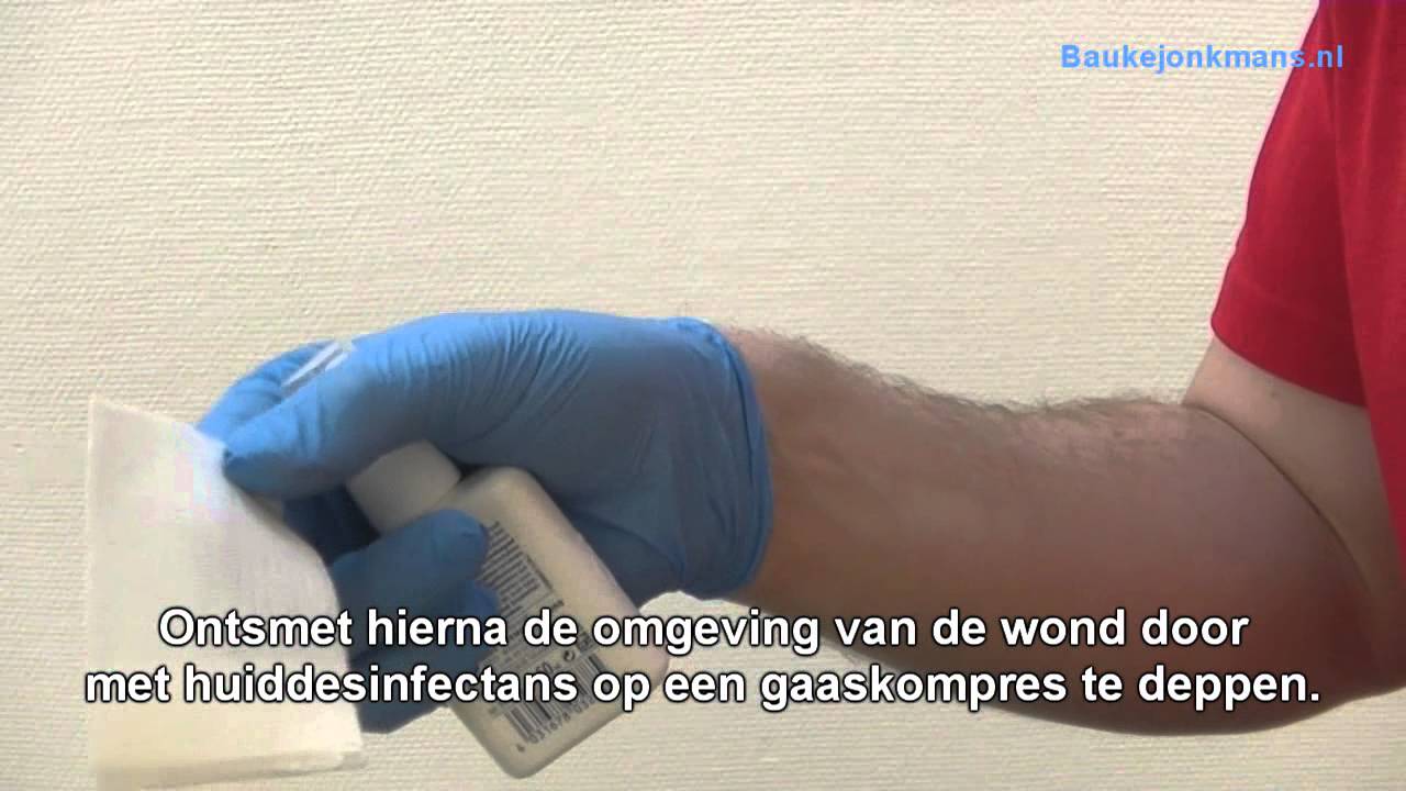 Splinter Verwijderen Youtube