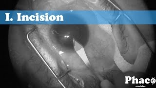 Phaco Annotated | I. Incision