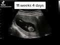 Big Stretch On Ultrasound At 11 Weeks 4 Days Pregnant