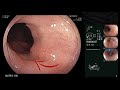 ESD of Early Gastric Cancer in the Cardia