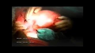 The 46 Year Pregnancy - Extraordinary People Documentary