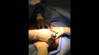 Resizing Areola in a Breast Lift