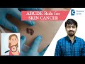 ABCDE Rule for early detection of Melanoma Skin Cancer #cancer - Dr. Rajdeep Mysore| Doctors' Circle