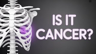 Rib Pain Causes & Cancer Risk: When to Worry About Persistent Chest Wall Pain