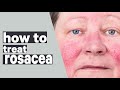 What is rosacea and how to I treat it? | The gift of healthy skin - Episode fourteen