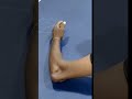 Puttur kattu 10 நொடிகளில் பறந்து போகும் வலி, Elbow Disloction Reduce Treatment 10 sec #putturkattu