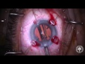 removal of cataract with pxf and phacodynesis new mcr by mst