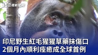 印尼野生紅毛猩猩草藥抹傷口 2個月內順利痊癒成全球首例｜20240506 公視新聞全球話