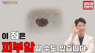 피부암 확인하는 방법 알려드립니다. 갑자기 생긴 점이 피부암이 걱정된다면? ABCDE로 판단해보세요. - 피부과전문의 닥터피부광