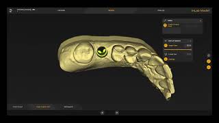 Design of a Gingiva Mask with inLab Software