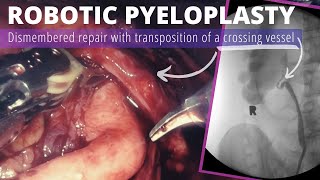 Robotic pyeloplasty for UPJ obstruction from crossing vessel