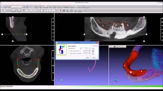 GuideMia Express Demo - Dual Scan - Implant treatment planning and surgical guide design